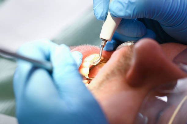 Best Emergency Tooth Extraction in Remerton, GA
